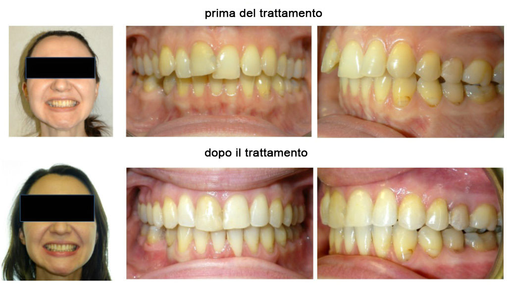 apparecchio prima e dopo