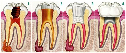 endodonzia, trattamento canali