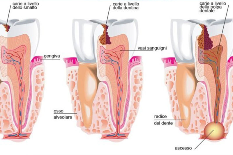 endodonzia