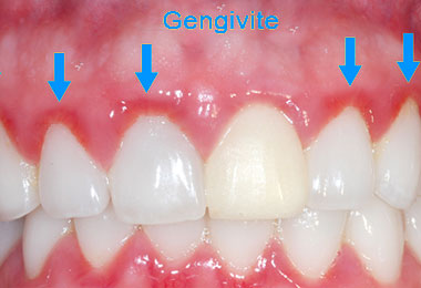 igiene_gengivite